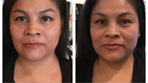HIFU vs Ultherapy: Technology & Results - lefislaser