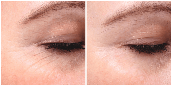 Pico Laser Healing Stages: From Redness to Collagen Remodeling - lefislaser