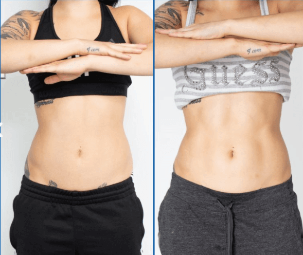 EMS Myoelectric Stimulation: How It Works, Benefits & Why It’s Transforming Fitness - lefislaser