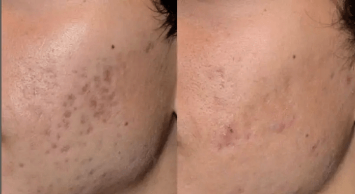 Picosecond Laser Before & After: Realistic Outcomes, Course Planning & Photo Standards