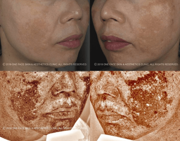 Picosecond for Melasma: Indications & Risks (A Clinic-First Guide)