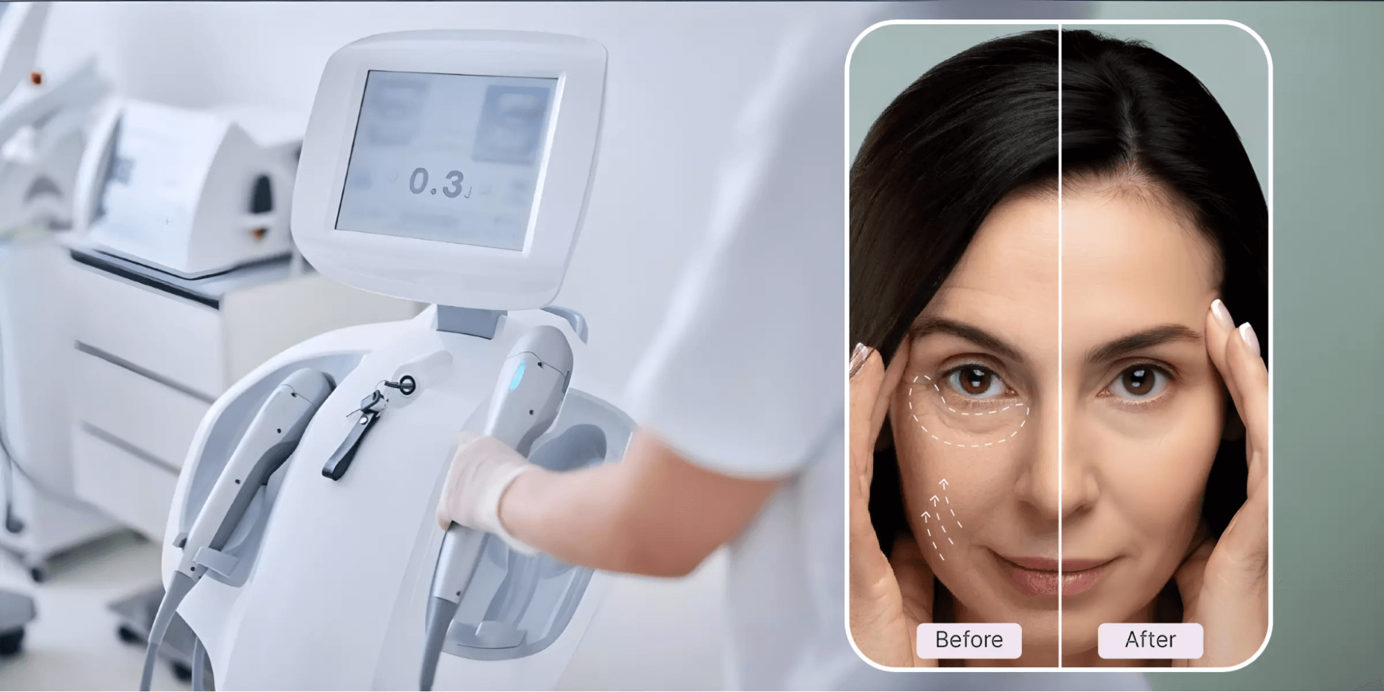 HIFU Machine Cost & ROI for Clinics - lefislaser