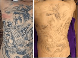 How Does Tattoo Removal Work? The Science of Shedding Your Past - lefislaser