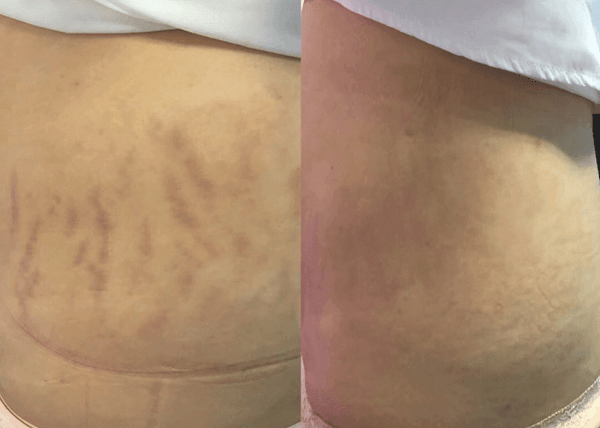 CO2 Fractional Laser: Calibration and Maintenance Guidelines for Clinics - lefislaser