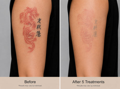 Colored Pigment Removal