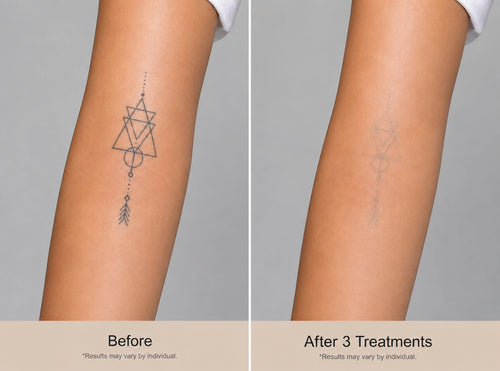 Fine Line Tattoo Correction