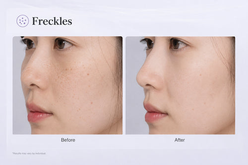 Freckles