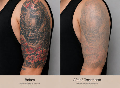 Large Area Tattoo Removal