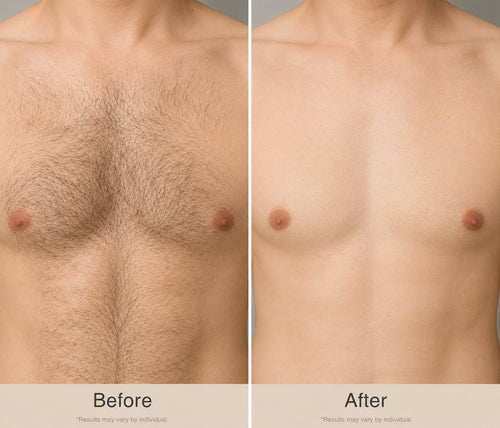 Chest Hair Removal