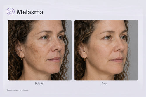 Melasma