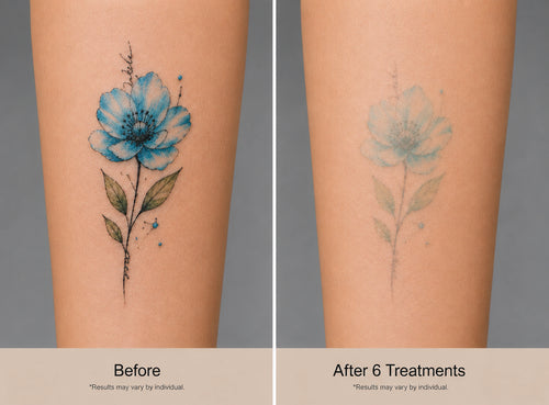 Multi-Color Tattoo Removal