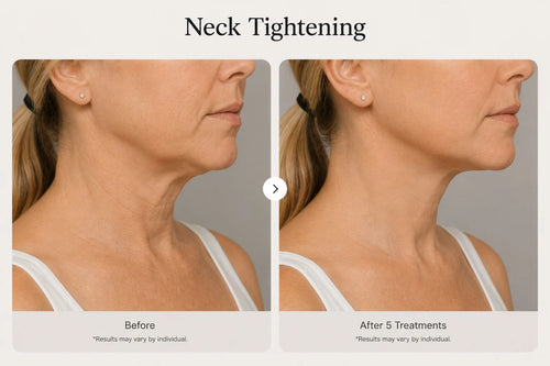 Neck Tightening