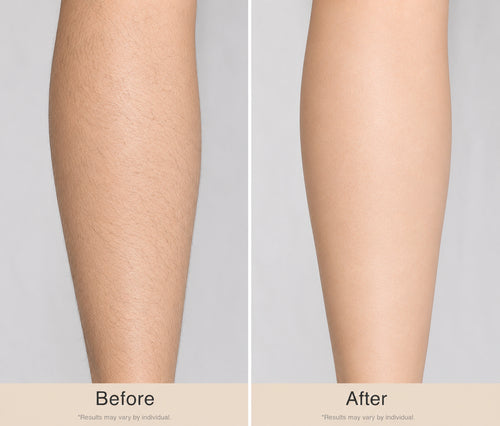 Legs Hair Removal