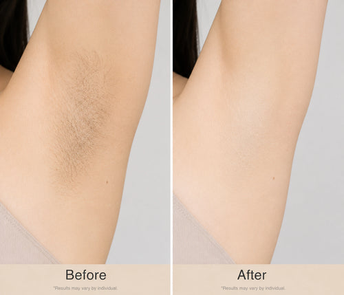 Underarm Hair Removal