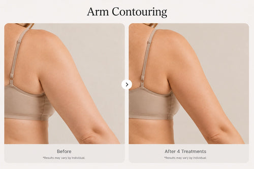 Case 4 — Arm Contouring